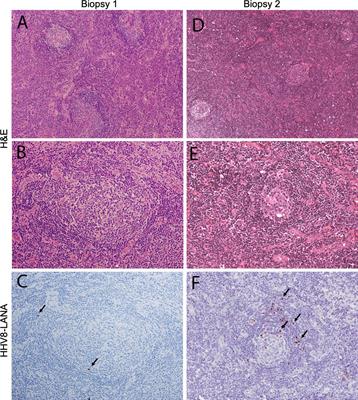 Case report: Multicentric Castleman disease as a manifestation of immune reconstitution inflammatory syndrome in Malawi